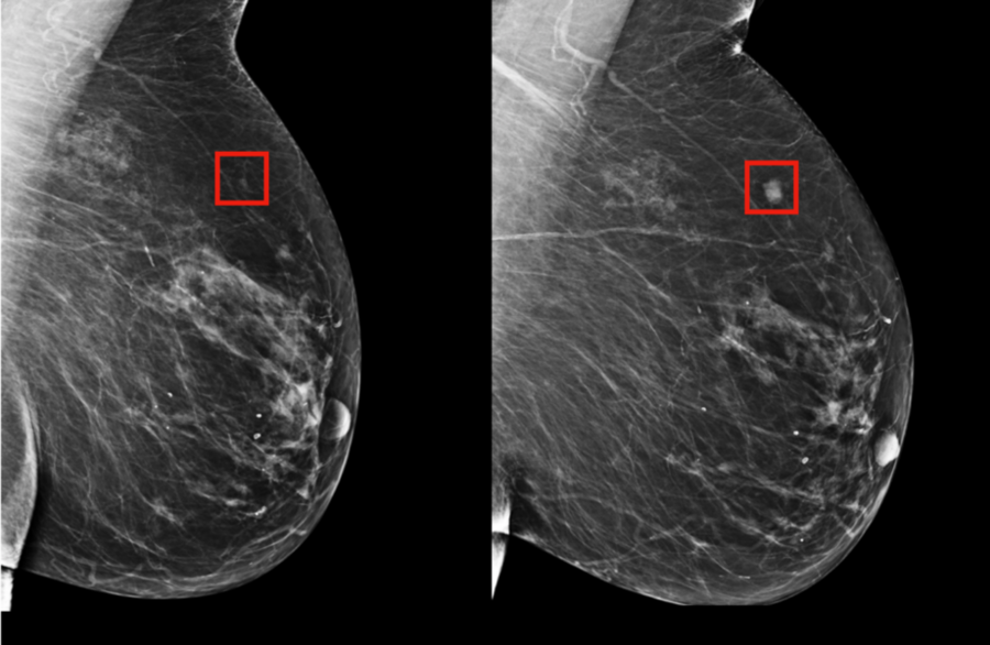 MIT AI model analyzing a mammogram to detect early breast cancer indicators up to 5 years before clinical diagnosis